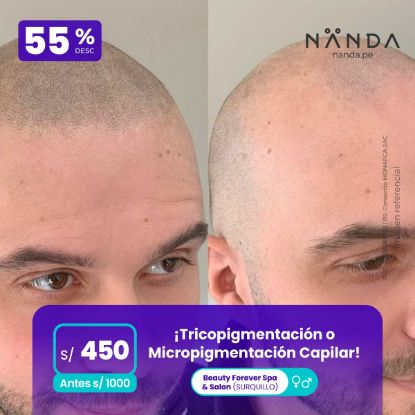 ¡Tricopigmentación o Micropigmentación Capilar! 😍 - Beauty Forever Spa & Salon (SURQUILLO)