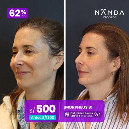 ¡MORPHEUS 8! 😍 - Piel y Salud Centro Estético (MIRAFLORES) 