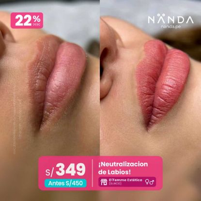¡Neutralización de Labios! 😍 - D'Femme Estética (SURCO)